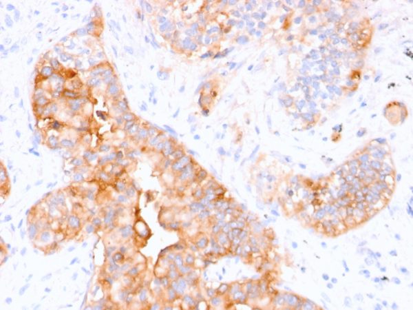 Formalin-fixed, paraffin-embedded human colon carcinoma stained with CEA Mouse Monoclonal Antibody (CEA31).