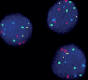 Cancer de la vessie - Nouvelle sonde FISH quadruple couleur